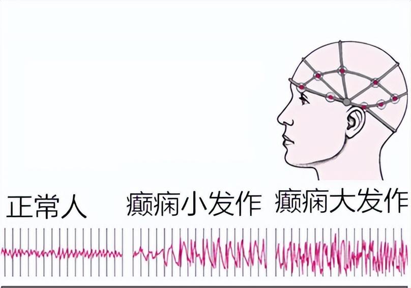 癇病最新治療方法概述，癇病最新治療方法概述與進(jìn)展